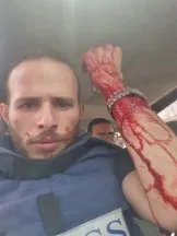 Wadeaa Abu Al-Saud shows his injured arm after being struck by shrapnel on July 1, 2025.