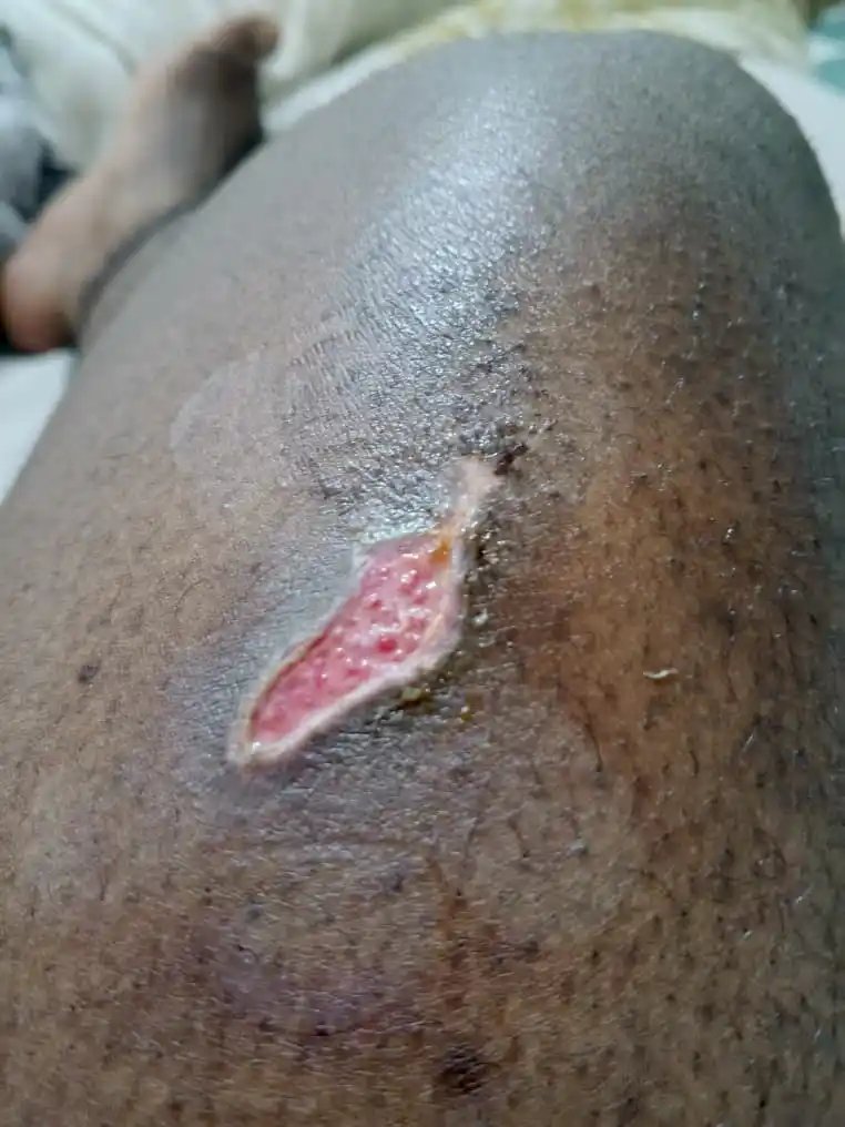 David Honneur Safari's right thigh was injured while in M23 detention.